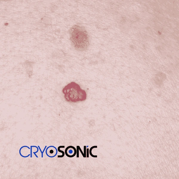 Looking for pain free cherry angioma removal treatment Slough? Call our team today! Slough
