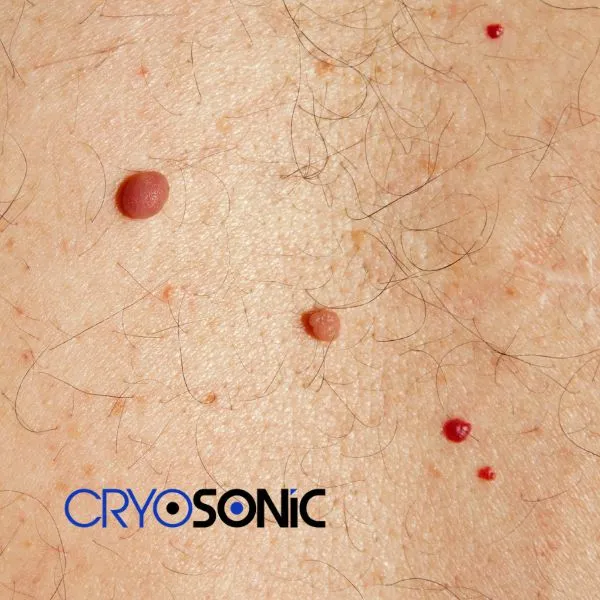 get cherry angioma removal treatment today! Slough