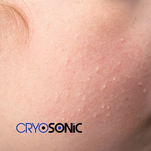 Are you looking for milia removal treatment? Contact our team today Slough
