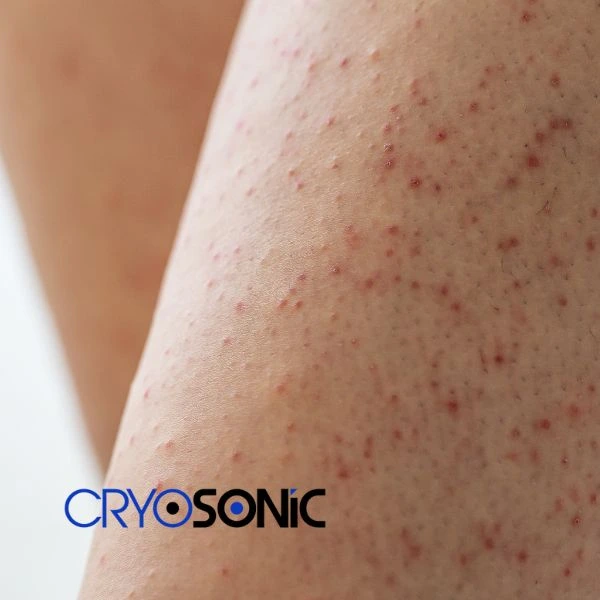 Looking for Seborrhoeic Keratosis removal Slough treatment? Call our consultants today in Slough