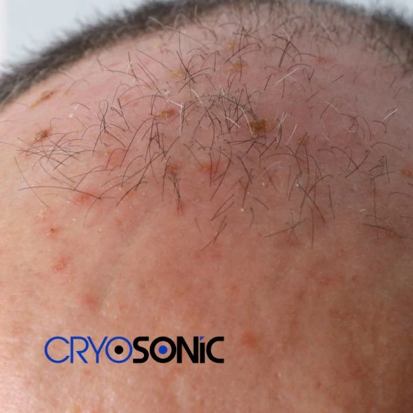 Access Seborrhoeic Keratosis removal from the comfort of your own home! Call us today in Slough