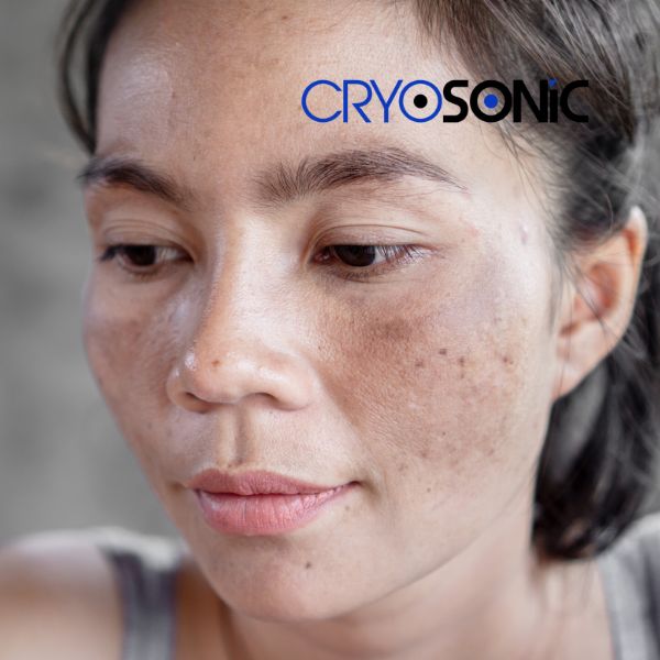 Ready to start age spots removal? Contact our team today in Slough