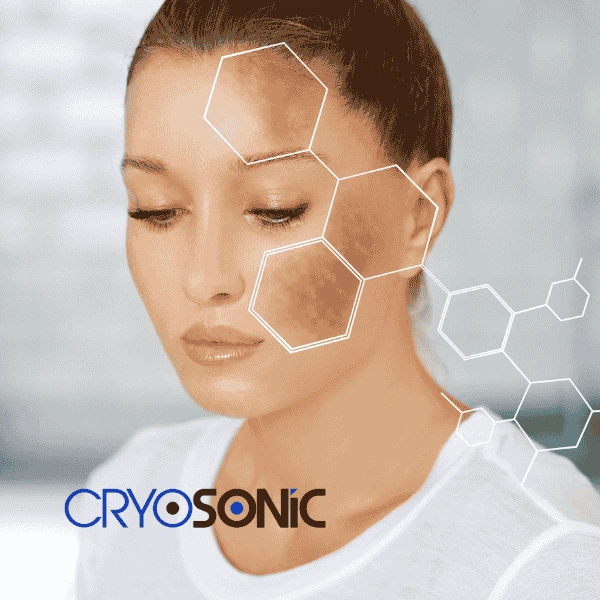Are you looking for age spot removal treatment? Contact Cryosonic today in Slough
