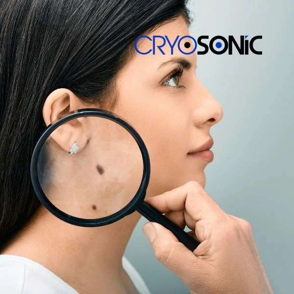 Do you want to learn more about benign moles removal treatment? Call our team today Slough