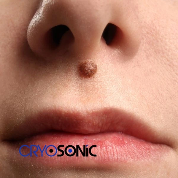 Start your benign moles removal treatment today Slough