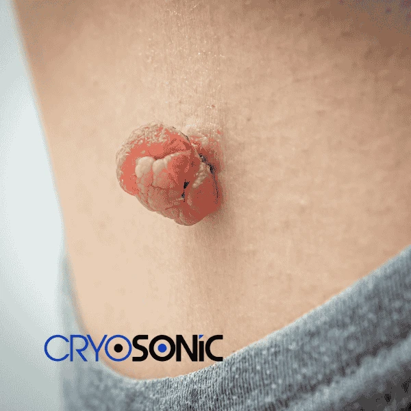 Book your skin tags removal Slough from comfort of your own home! Slough