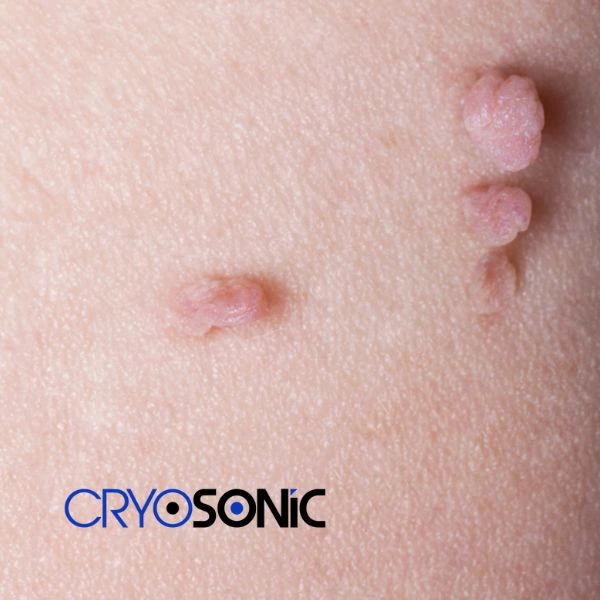 Are you looking for fast effect skin tag removal Slough? Book in NOW! Slough