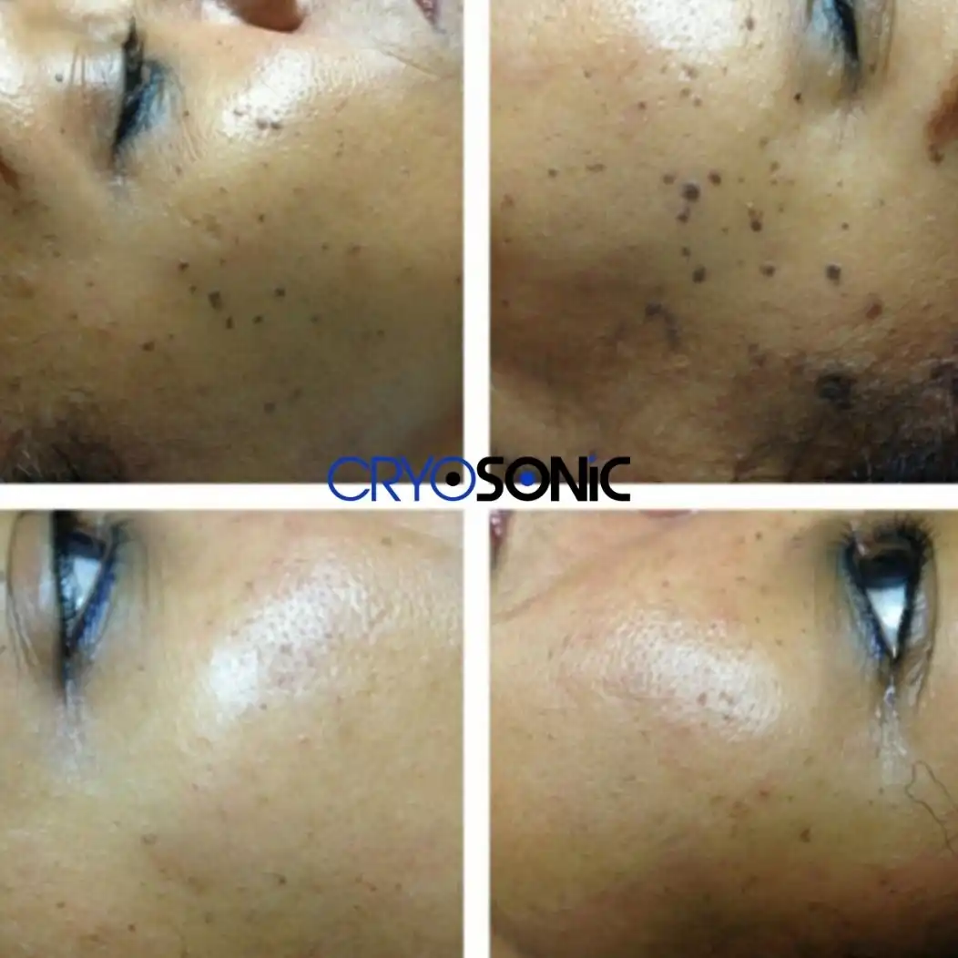 Why Skin Shows Pigmentation After Treatment Slough