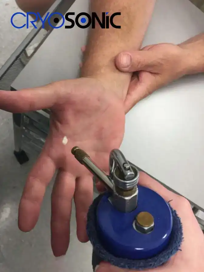 Temperature Differences: OTC vs Medical-Grade Cryotherapy Slough